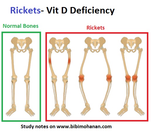 Rickets- Vitamin D Deficiency