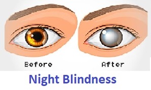 night blindness-vitamin A deficiency diseases